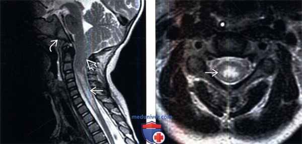 МРТ при сирингомиелии
