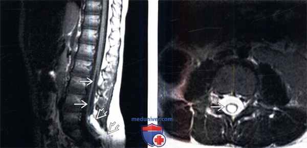 МРТ при сирингомиелии