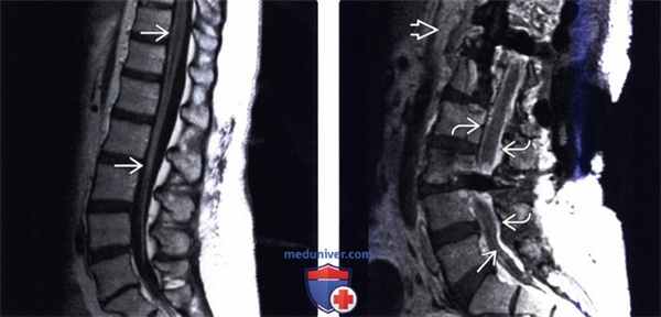 МРТ спинального менингита