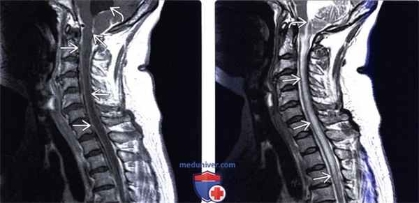 МРТ спинального менингита