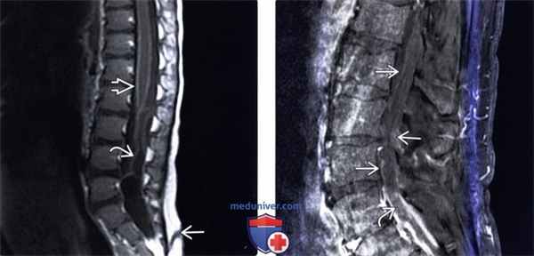 МРТ спинального менингита