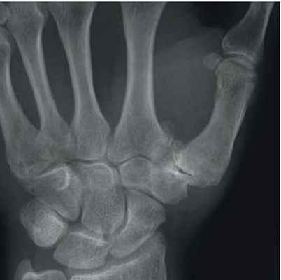 Odteoarthritis
