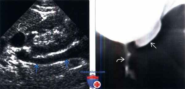 УЗИ, урография при удвоении и эктопии мочеточника