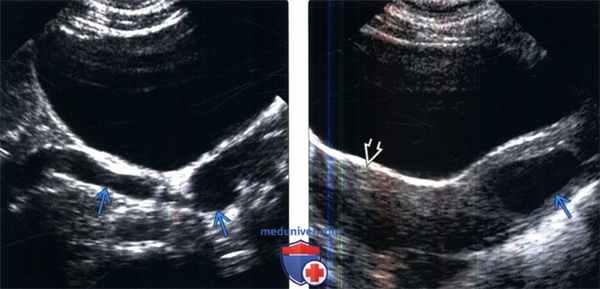 УЗИ при удвоении и эктопии мочеточника