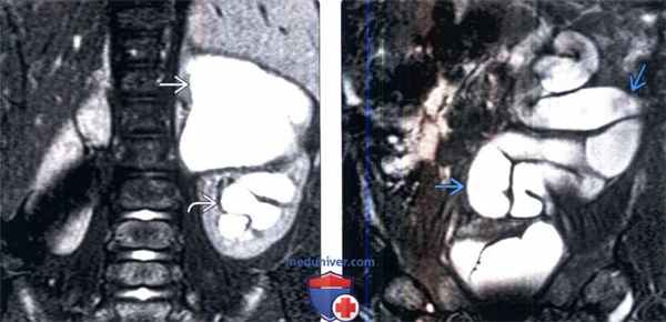 МРТ при удвоении и эктопии мочеточника