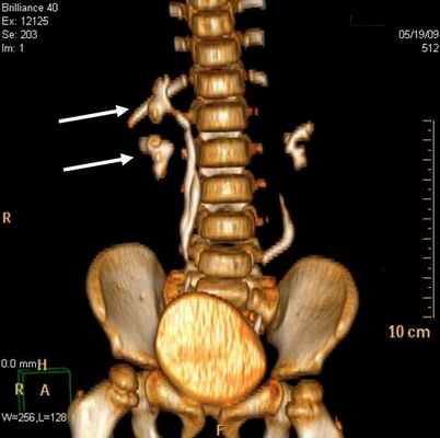 Рис 3. МСКТ картина уретероцеле. Трехмерная реконструкция. Удвоение почек и мочеточника справа (a) и уретероцеле слева (б)
