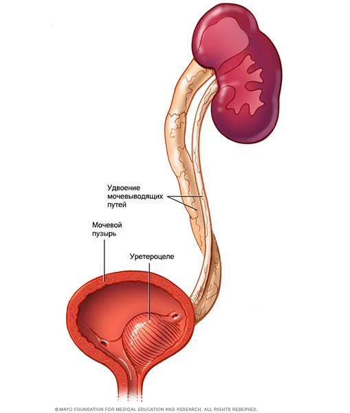 Удвоение мочевыводящих путей [16]