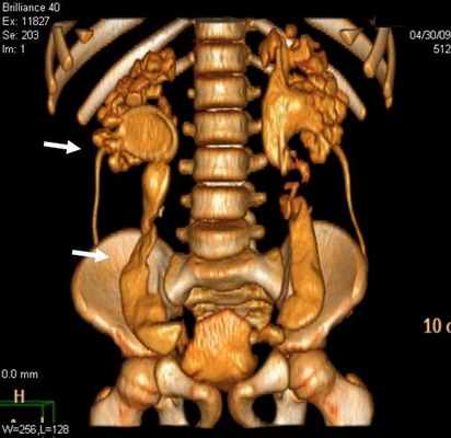 Рис 2. Уретерогидронефроз (a, б) у больных с пороками развития уретеровезикального сегмента