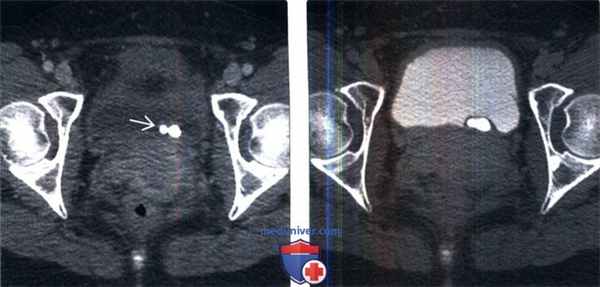 КТ, МРТ, урография при уретероцеле