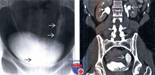 КТ, МРТ, урография при уретероцеле