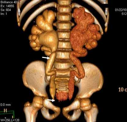 Рис 4. Стеноз устья мочеточника. Трехмерная реконструкция. Больной К., 6 лет. Деформирование мочеточников и сужение устья мочеточников