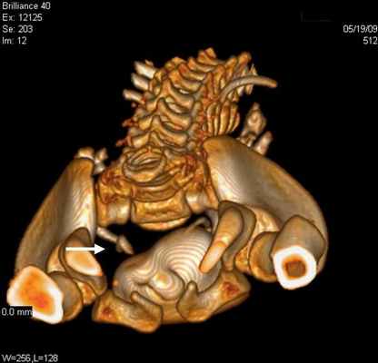 Рис 3. МСКТ картина уретероцеле. Трехмерная реконструкция. Удвоение почек и мочеточника справа (a) и уретероцеле слева (б)