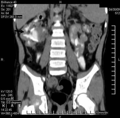 Рис 2. Уретерогидронефроз (a, б) у больных с пороками развития уретеровезикального сегмента