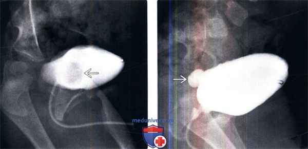 КТ, МРТ, урография при уретероцеле