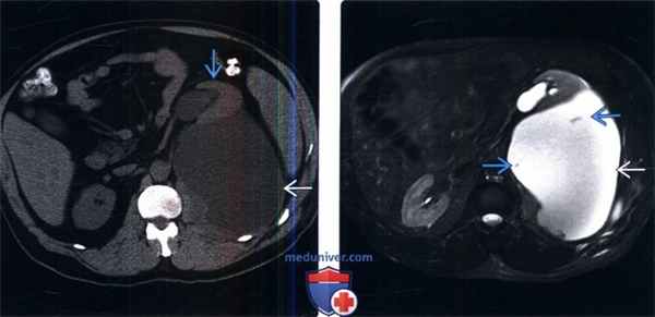 КТ, МРТ при уриноме