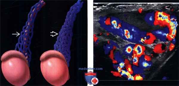 УЗИ при варикоцеле