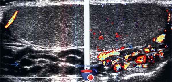 УЗИ при варикоцеле