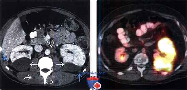 КТ, МРТ при забрюшинных метастазах