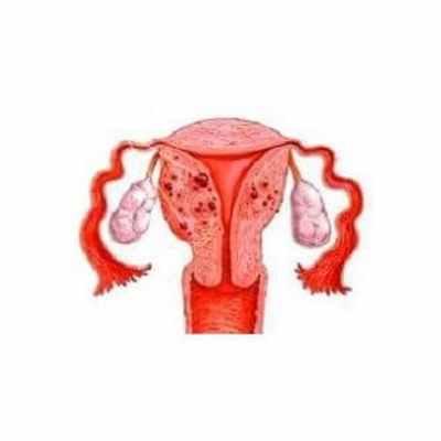 Аденомиоз матки