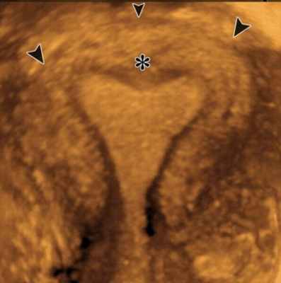 Сідловидна матка