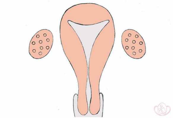 Частичная агенезия (отсутствие) или гипоплазия (недоразвитие) мюллеровых протоков. Трубная