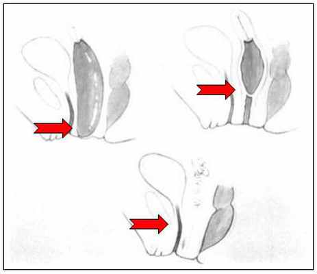 Атрезия влагалища