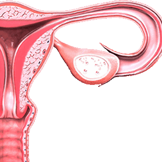 Лейомиома матки