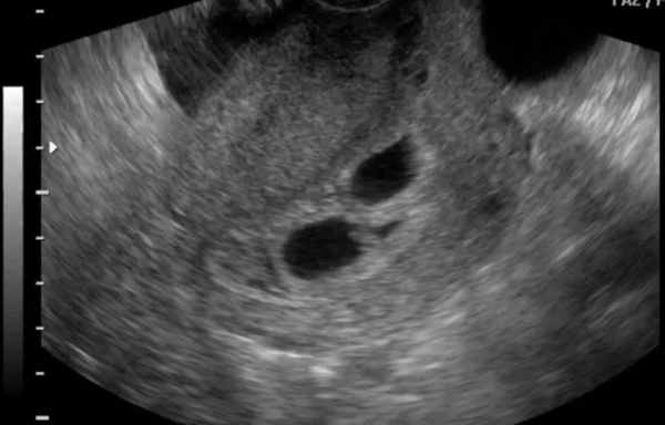 Снимок УЗИ двойни