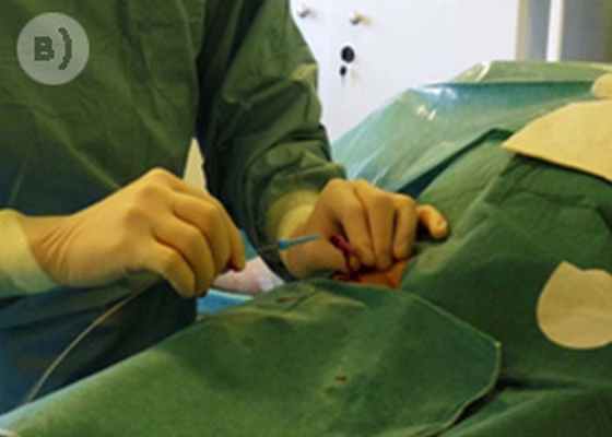 Лечение миомы матки методом эмболизации маточных артерий. Пункция артерии