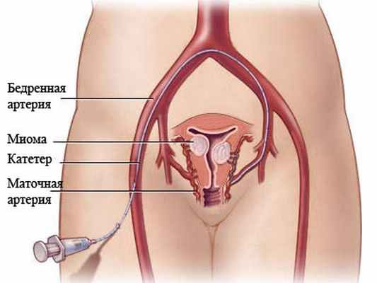 endometrioz matki 01