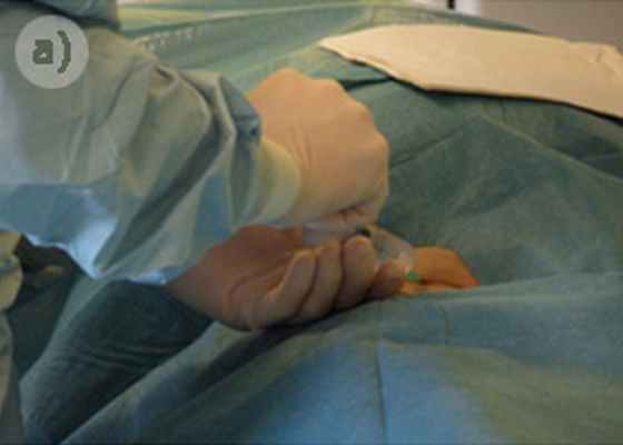 Эмболизация миомы матки. Операция