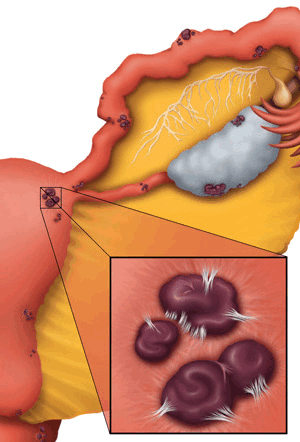 Очаги эндометриоза