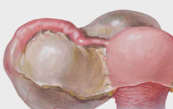 Гидросальпинкс: причины, симптоматика, эффективные методы лечения