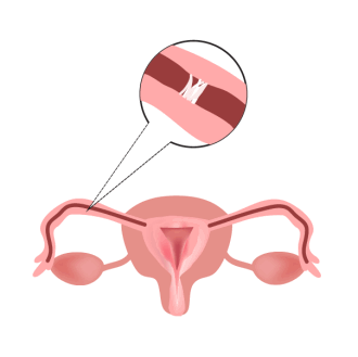 Непроходимость маточных труб