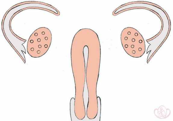 Частичная агенезия (отсутствие) или гипоплазия (недоразвитие) мюллеровых протоков. Маточная