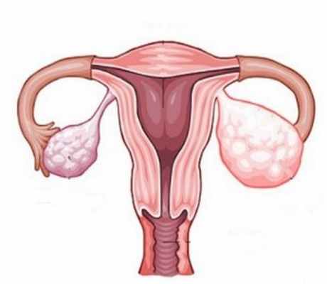 Стромальные опухоли яичников