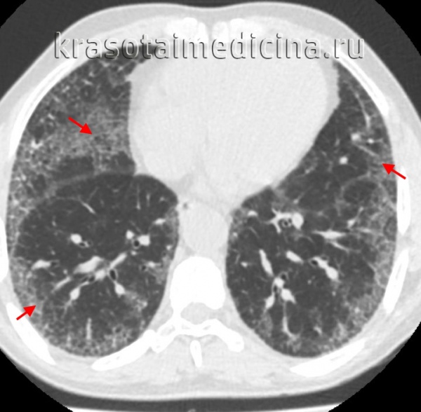 Интерстициальная пневмония