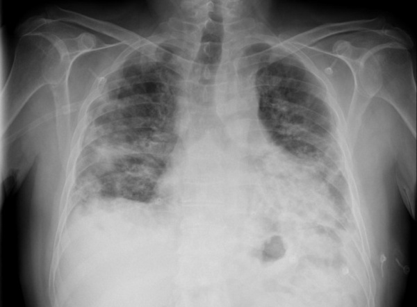 Криптогенная организующаяся пневмония