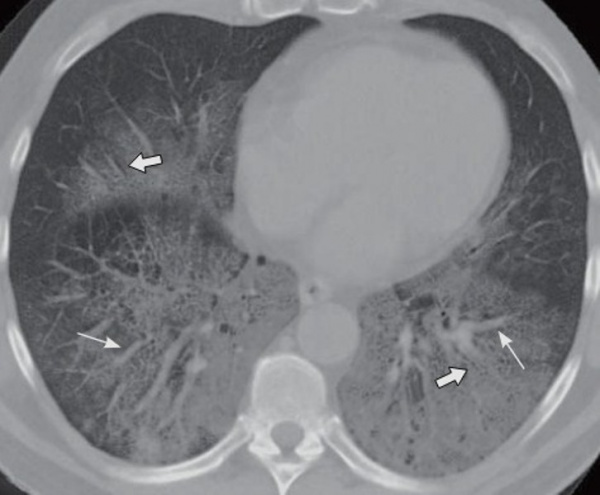 Липоидная пневмония