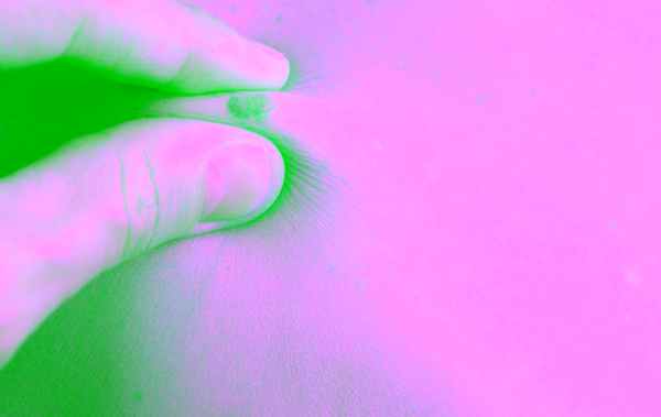 Лучевая терапия при меланоме