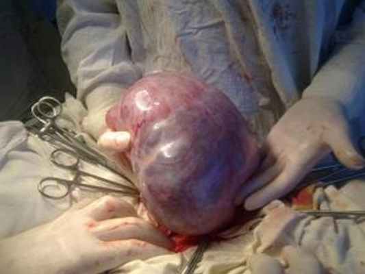 Ввиду позднего обращения, злокачественная опухоль яичника у пациентки достигла значительных размеров