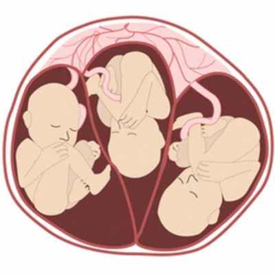 Многоплодная беременность