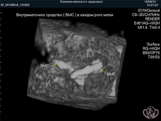 Двурогая матка