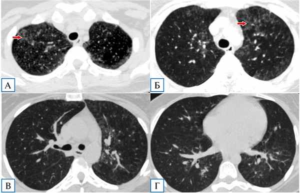 Фото Пневмоцистная пневмония