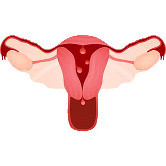 Полипы матки