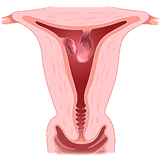 Полип эндометрия