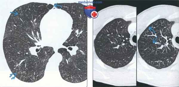 Лучевые признаки респираторного бронхиолита