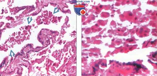 Лучевые признаки респираторного бронхиолита