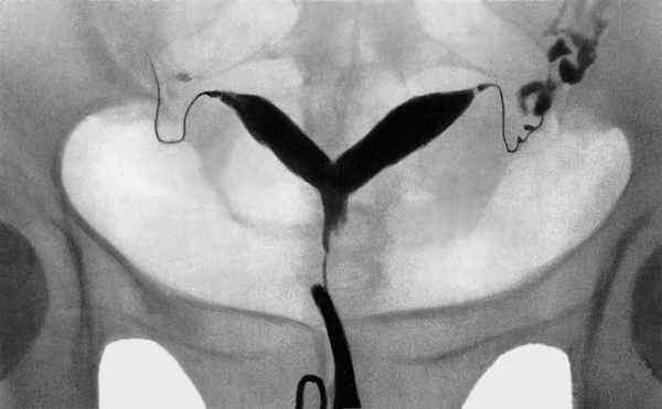Метросальпингографические данные при двурогой матке