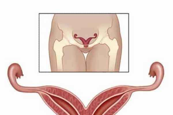 двурогая матка